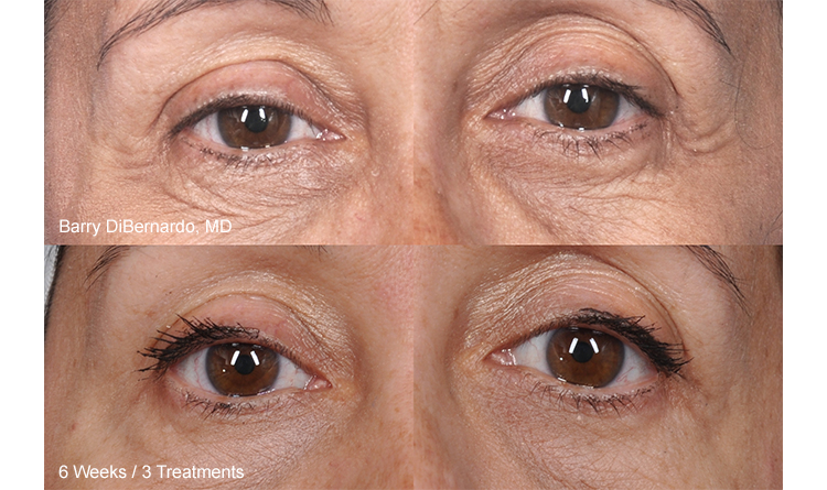 Thermismooth Results