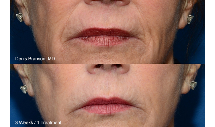 Thermismooth Results